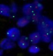 Elhagyhatók-e az anthracyclinek magas kockázatú (high-risk) HER2-negatív mellrák adjuváns kezelése esetén? Elhagyhatók-e az anthracyclinek magas kockázatú (high-risk) HER2-negatív mellrák adjuváns kezelése esetén?